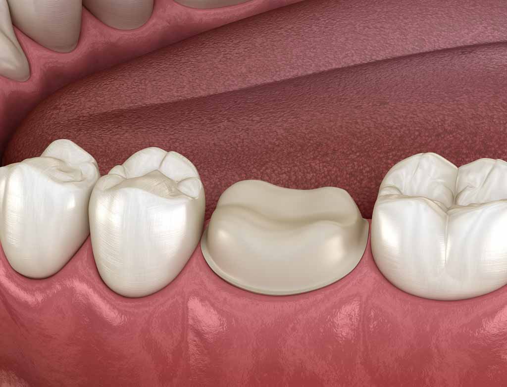 dental crown content