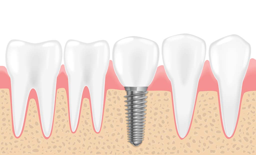 dental implant content