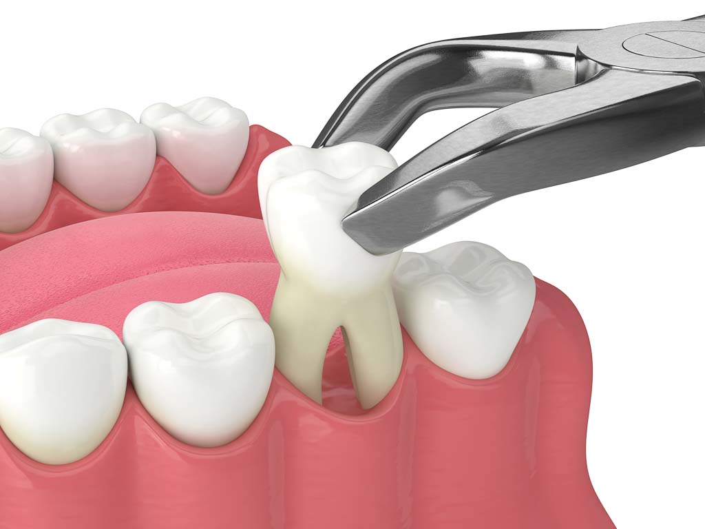 dental extraction content