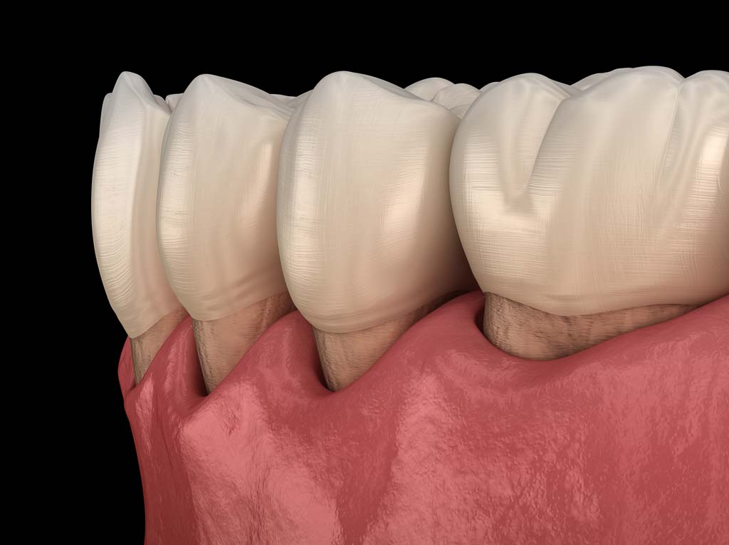 gum recession content