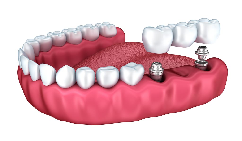 implant bridge content