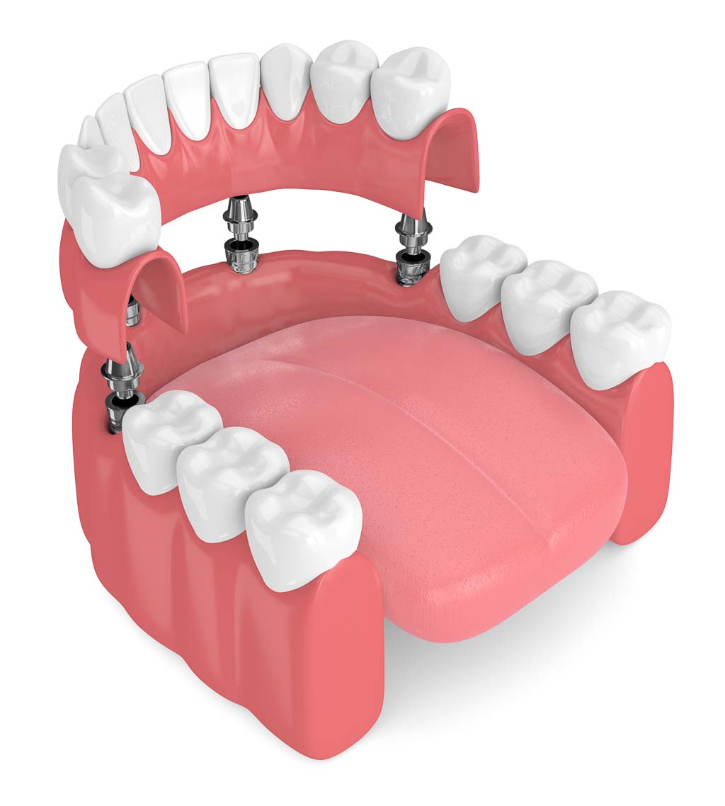 implant denture content