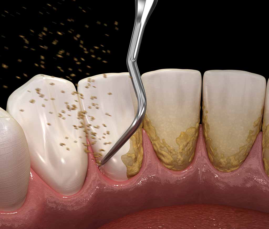 periodontal treatment content