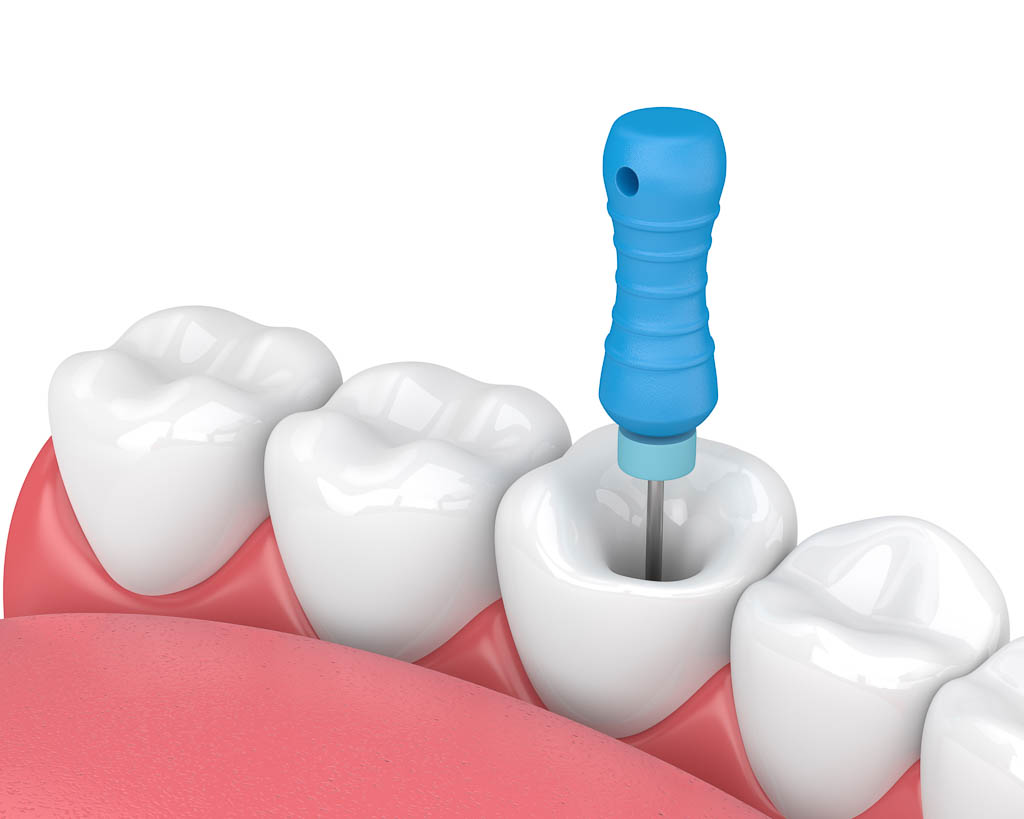 root canal treatment content