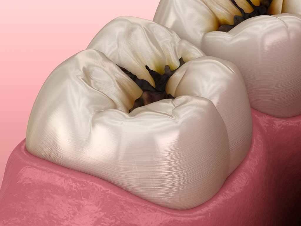 dental sealant content