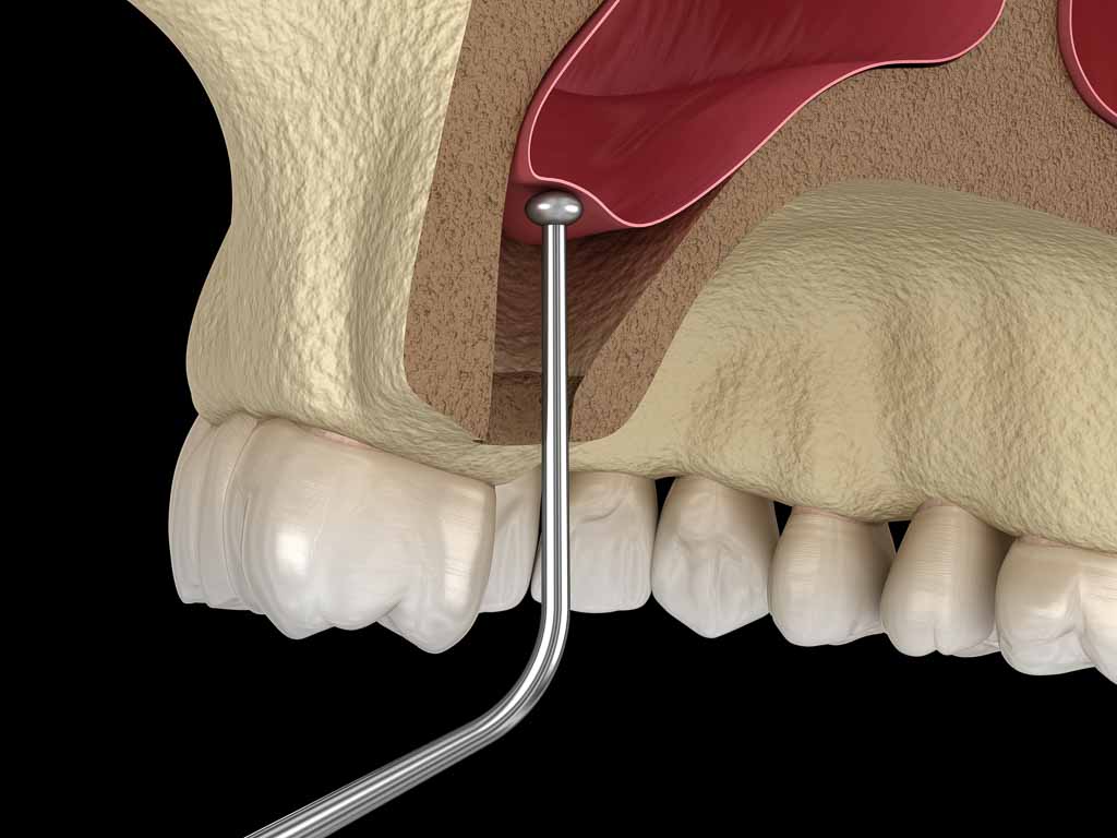 sinus lift content