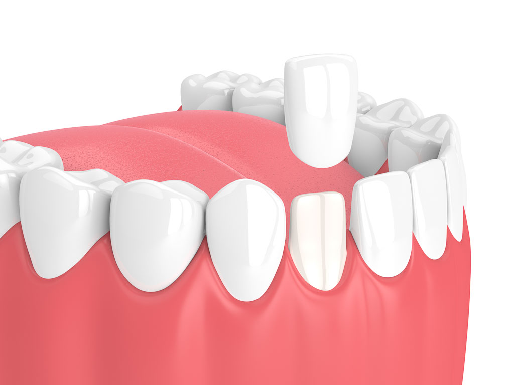 dental veneer content