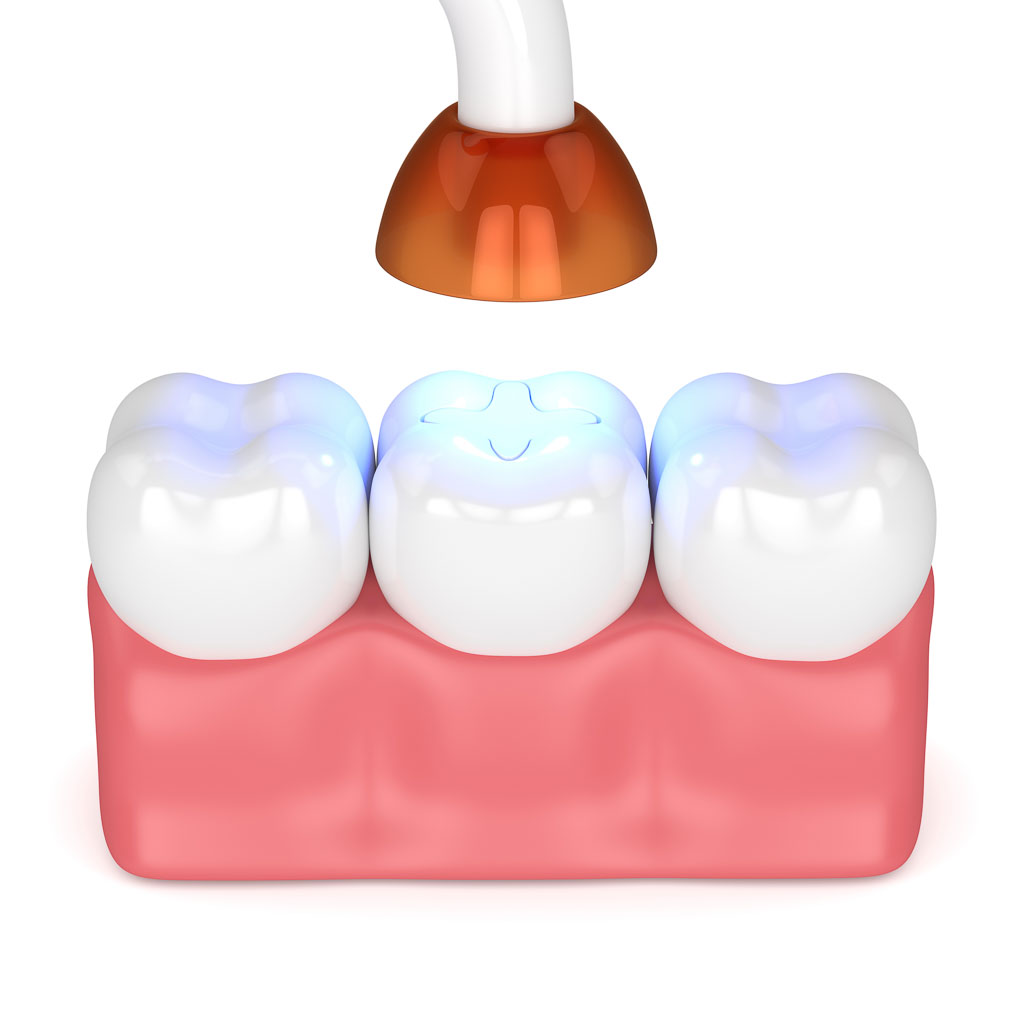 composite filling content